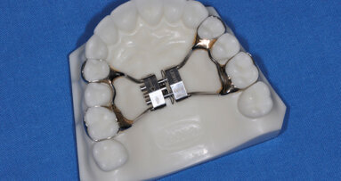 Espansione del mascellare superiore con il Leaf Expander®