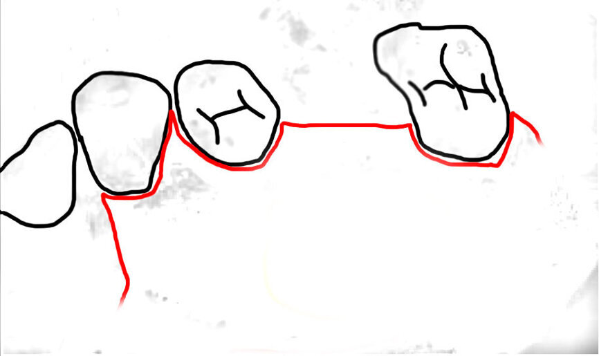 Ryc. 1a_Nacięcie i odwarstwienie płata śluzówkowo-okostnowego. Cięcie rozpoczęto na szczycie wyrostka, w okolicy kła/zębów przedtrzonowych wykonano cięcie uwalniające.