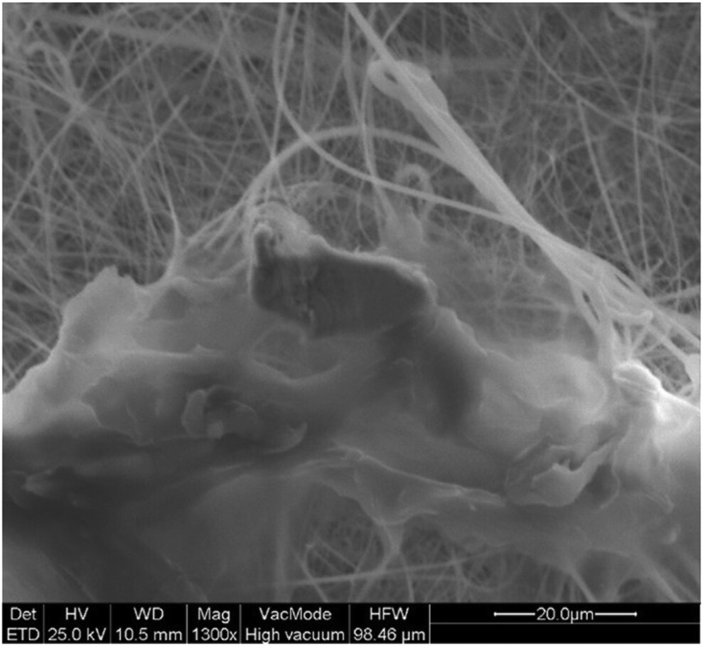Fig. 1: Invisalign aligners immersed in deionised water under agitation for seven days, without using an attachment-bonded arch or simulating masticatory function, released particulate aggregates that were retained on 1 μm fibreglass filters. Scanning electron microscopy showed micron-scale debris adhering to the filter surface (1,300 ×; scale bar: 20 μm; image: Dr Nearchos Panayi et al.).