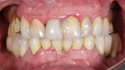 Novel digital workflow for full-arch rehabilitation