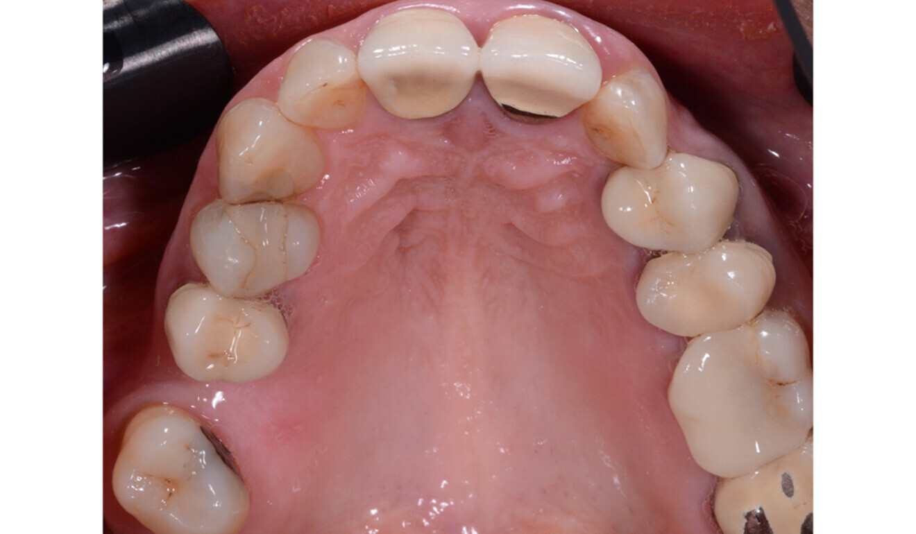 Fig. 5: Occlusal view of the maxillary teeth.