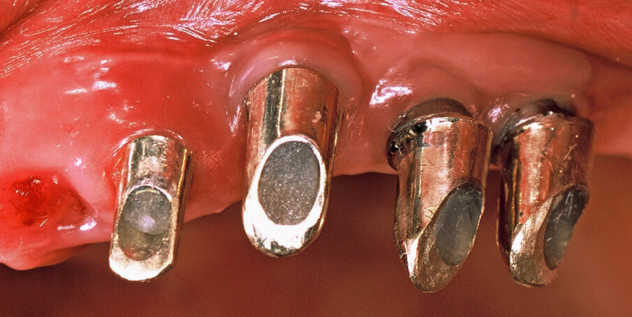 Fig. 9. Customized gold implant abutments.