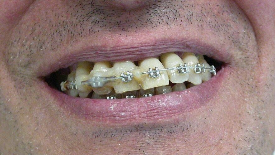 Ogni promessa è debito… (anche in odontoiatria)