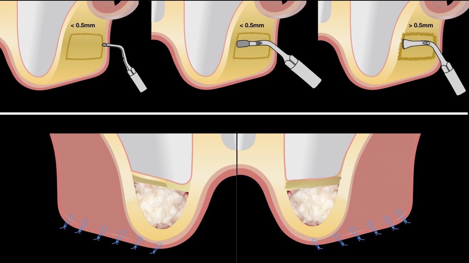 Piezocirugía  (9). Ventajas del piezoeléctrico en la terapia sinusal