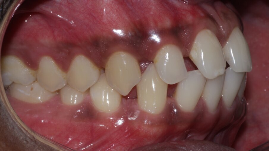 Fig 2: Pre op in occlusion