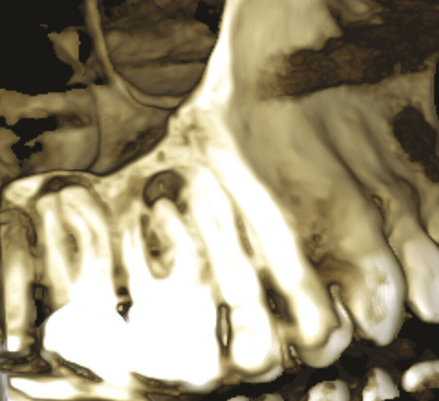 Figg. 1d, 1e - Un’altra lesione periapicale sta interessando il secondo molare.