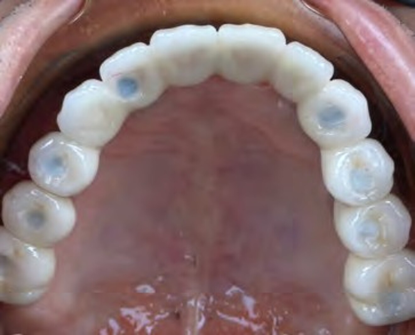 Fig. 3i: Maxillary occlusal view showing the definitive full-arch implant-supported prosthesis following insertion.