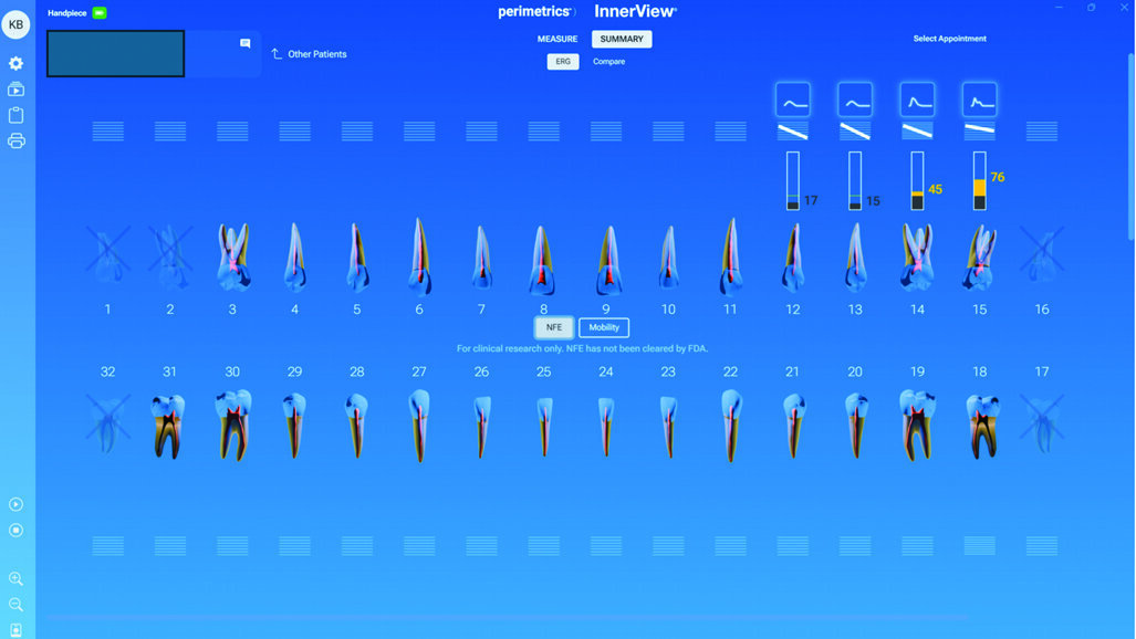 Beyond X-rays: How InnerView is changing the way we quantify implant stability