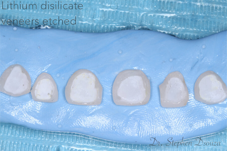 Fig 13: Etched veneers