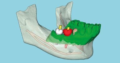 Flusso di lavoro digitale  e intelligenza artificiale  in implantologia