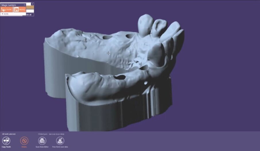 Figg. 21-25_Progettazione Cad con exocad.