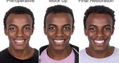 Veneer restoration: Calibrated preparation to close diastemas