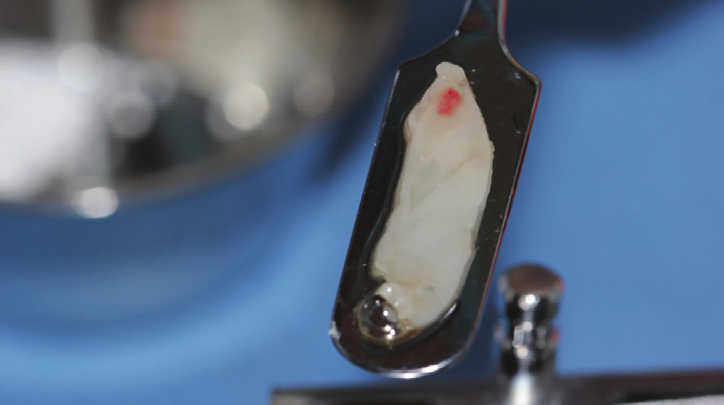 Figure 15: L-PRF membranes formed in specially fabrication kit.