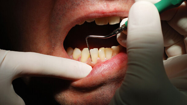 Geschmacksgene beeinflussen Kariesvorkommen