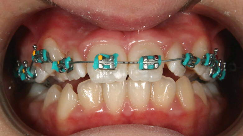 Jak zjednodušit léčebný protokol použitím drátu čtyřhranného průřezu v první fázi léčby