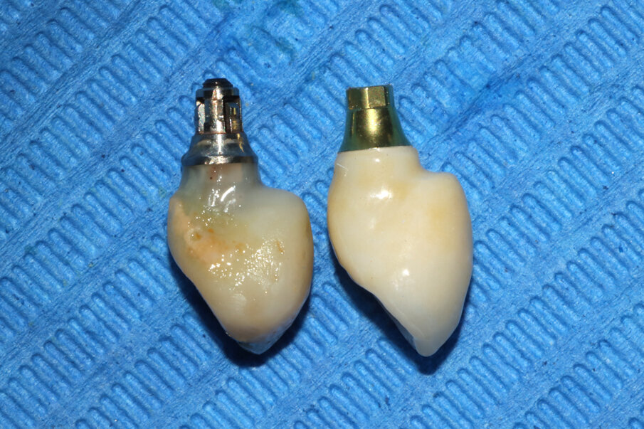 Fig. 15_Il tragitto transmucoso del provvisorio viene rilevato durante la scansione e ripetuto nella corona definitiva.