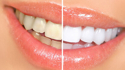 Zahnaufhellung – eine sichere Behandlung? Zahnaufhellung – eine sichere Behandlung?