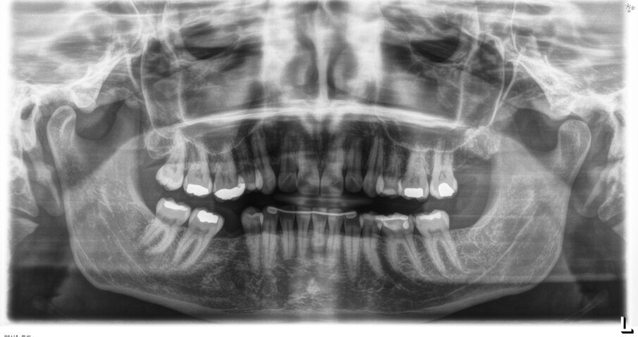 Fig. 3 - Ortopantomografia pre-trattamento.