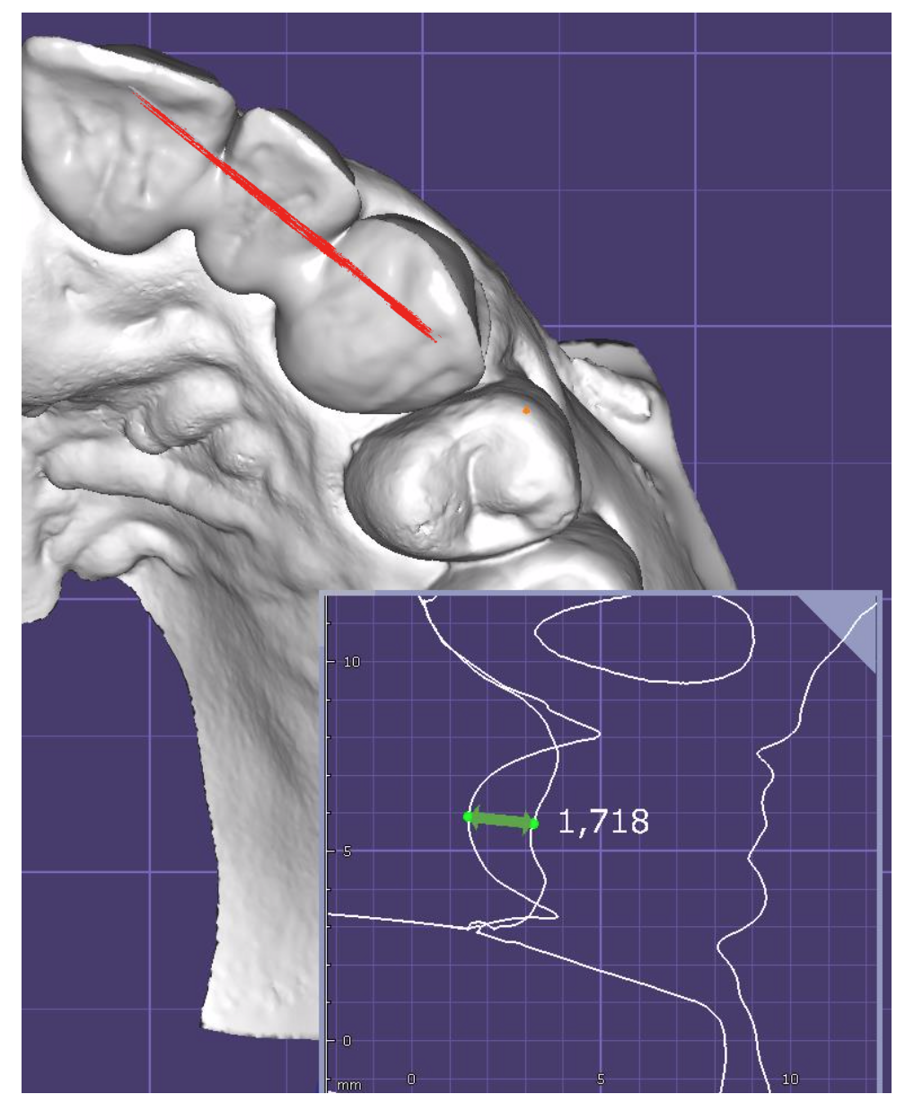 Fig. 24_Sezione della sovrapposizione delle scansioni a livello del 2.2. Il provvisorio crea un condizionamento di 1,72 mm.