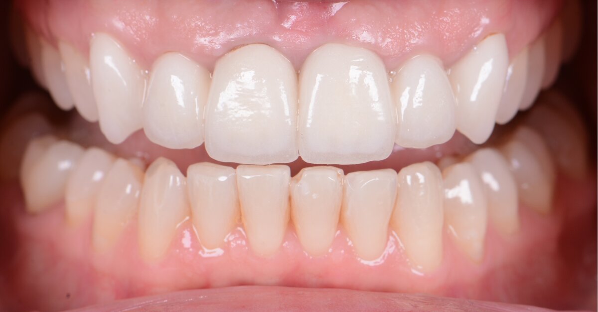 Digital workflow produces 20 natural zirconia and veneer restorations