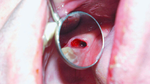 Atraumatické extrakce s Luxator Periotome