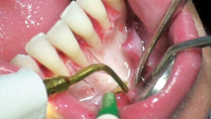 Šest klíčů pro účinné využití alveolární kortikotomie