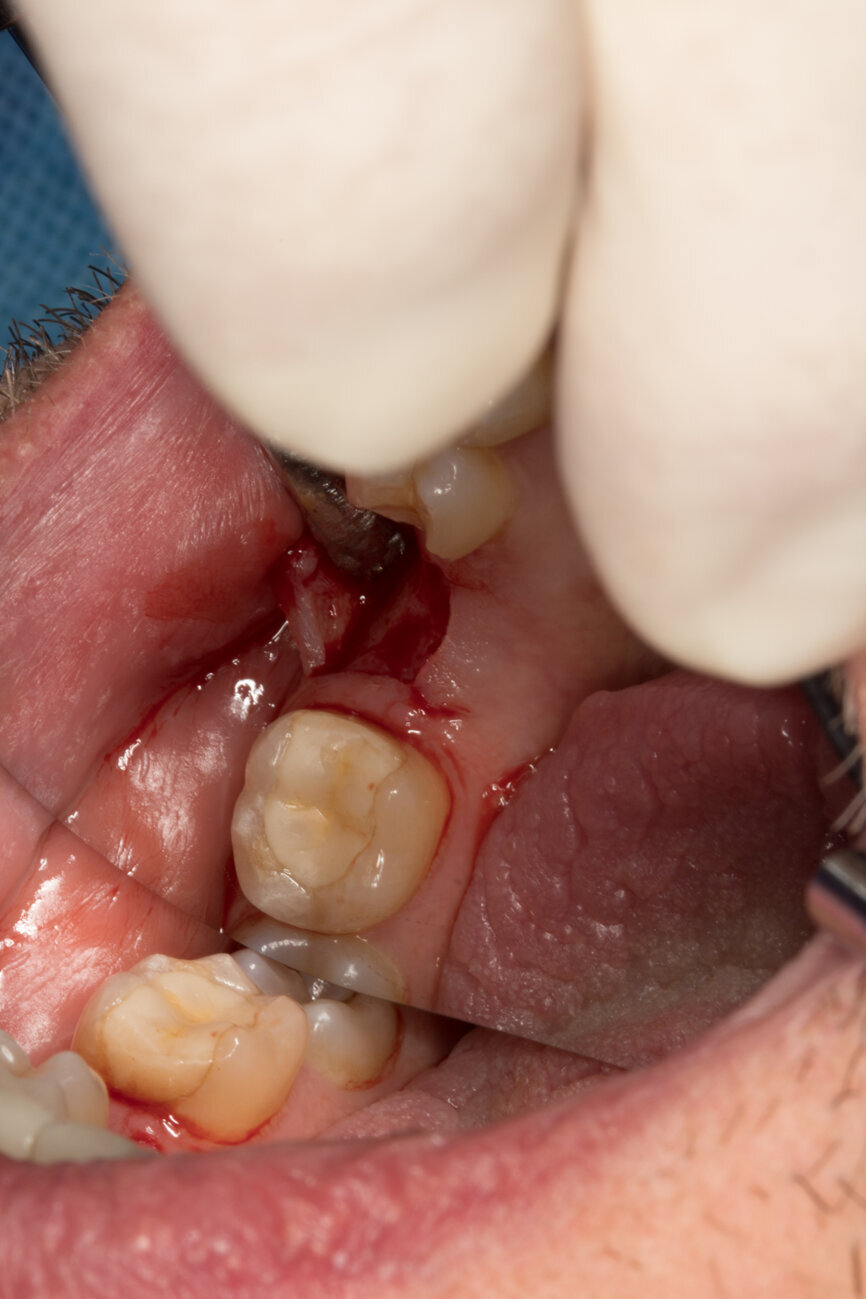 Ryc. 4-5_Odsłonięcie płata śluzówkowo-okostnowego.