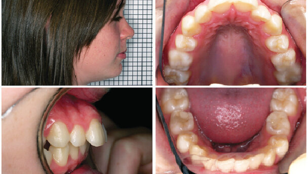 Recidiva: problém, o kterém se nikomu nechce diskutovat. Recidiva zůstává Achillovou patou ortodoncie, ale je skutečně tak těžké se o ní bavit?