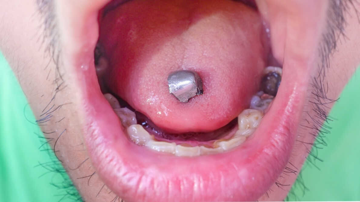 FDA promenio stav o dentalnom amalgamu