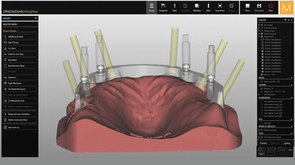 Tecnica “Double Screw Metal”
