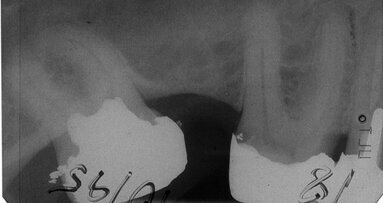 Die Vitalamputation permanenter Zähne