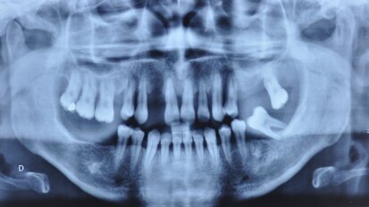 L’harmonisation du plan de traitement prothétique