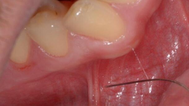 Kilka (z wielu) technik bezpiecznego i bezbolesnego znieczulania