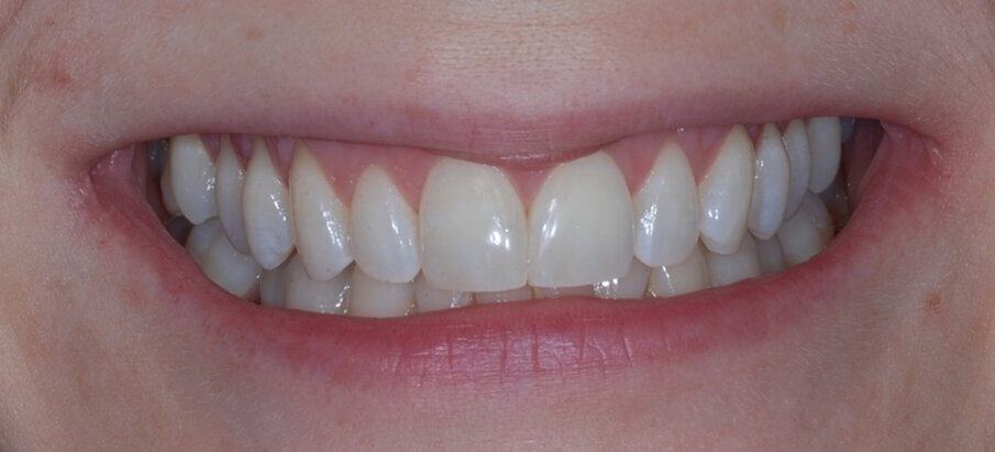 Fig. 15: Post treatment anterior