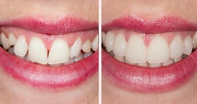 Von der Planung bis zur Realisierung: Experte referiert über Adhäsiv-Verfahren