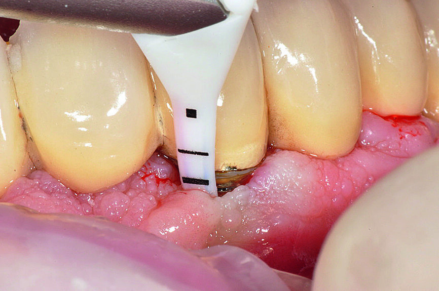 Figs. 5b : Élimination professionnelle du biofilm péri-implantaire par PERIOFLOW avec poudre PLUS 