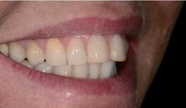 Afbeelding 1-4: Mondfoto’s en intraorale scans. In een eerste bezoek werd de wens met de patiënt besproken en werd er een aantal mondfoto’s gemaakt.