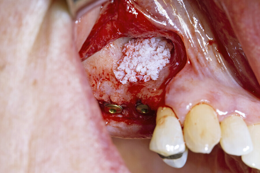 Fig. 8: Symbios Xenograft Granules layered over the autogenous bone.