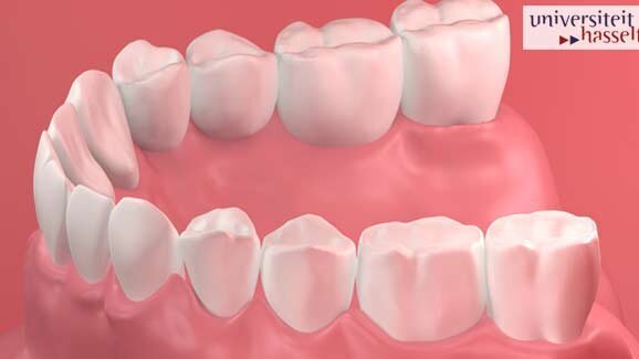 Kiefertransplantat mit 3D-Drucker hergestellt