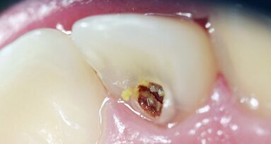 “Houd voorstadia van cariës goed in de gaten”