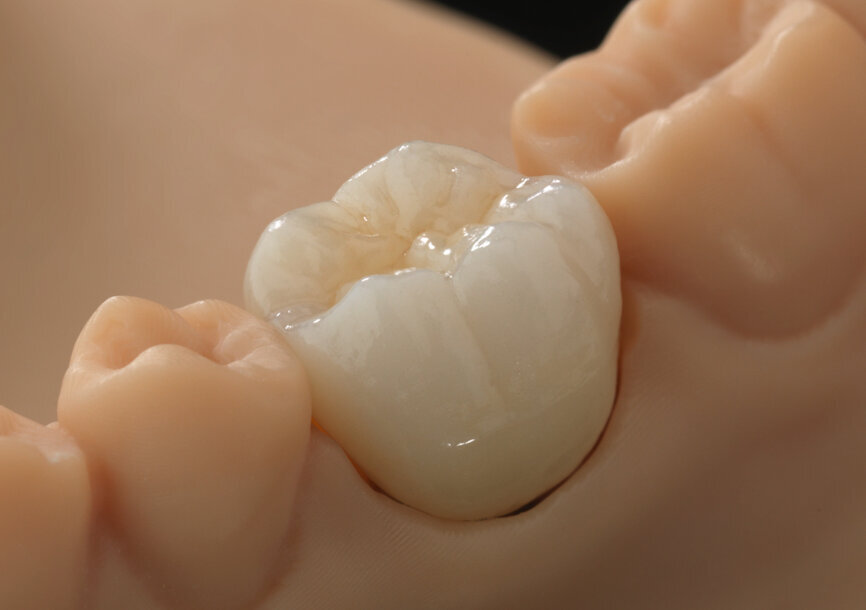 Zolid DRS wurde 2021 von Amann Girrbach auf den Markt gebracht und ermöglicht das Hochgeschwindigkeitssintern von Kronen in 20 Minuten. © Benni Votteler/Dentaltechnik Votteler