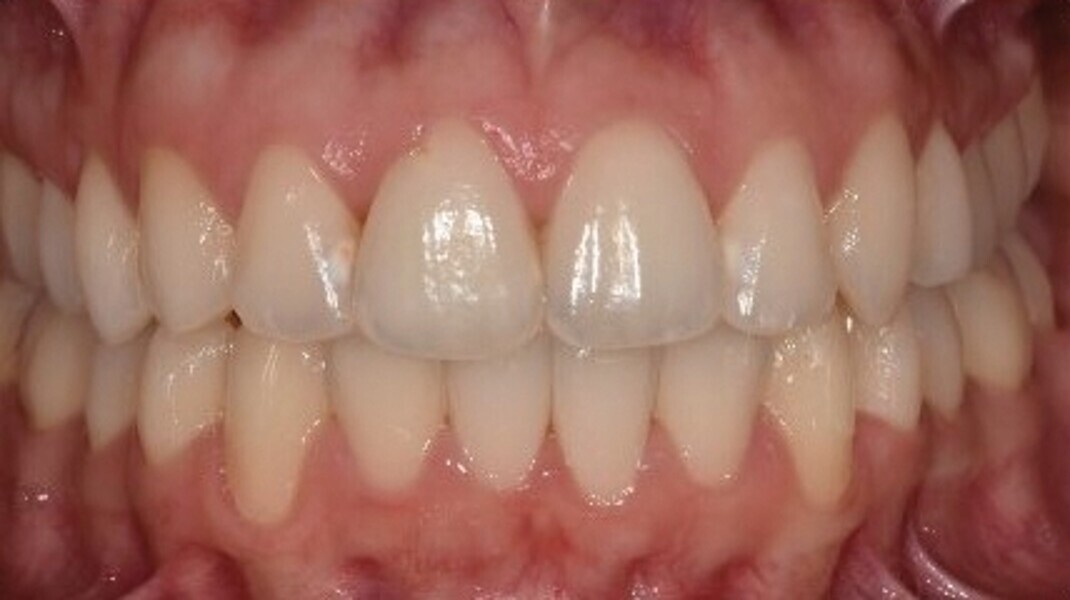 Fig. 6d : Photographie intraorale finale.