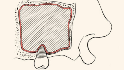 Colocación de una prótesis híbrida maxilar para  la rehabilitación fija del edéntulo con reabsorción severa