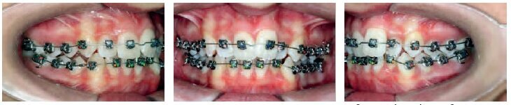 U & L Initial Bonding: U & L 014 CN