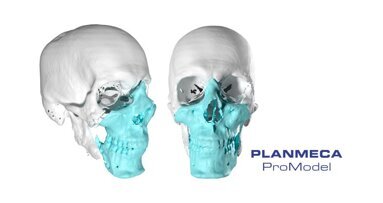 Second face transplant operation in Nordic countries performed in Finland