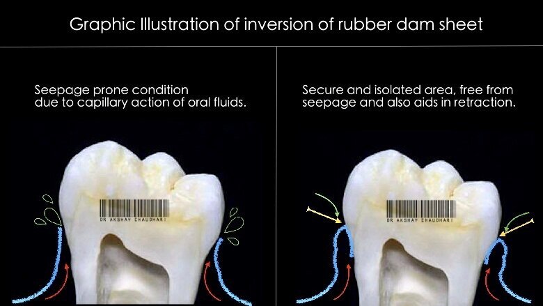 Fig - 7 Rubber dam inversion