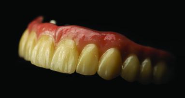 Nexus iOS: A complete digital solution for full-arch rehabilitation