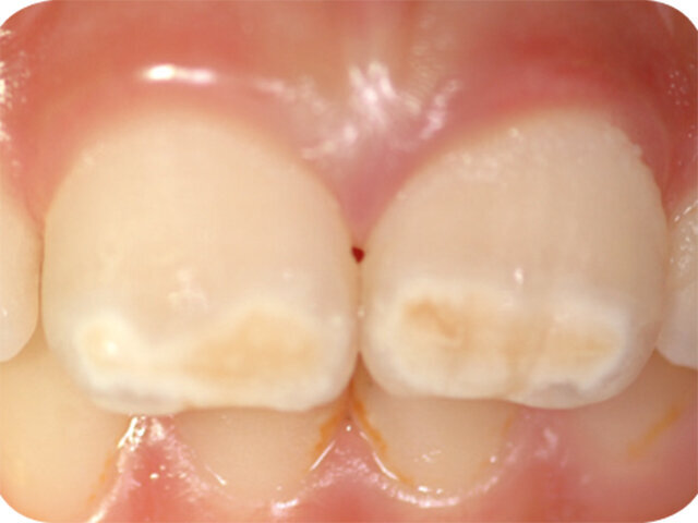 Postižené řezáky v rámci MIH