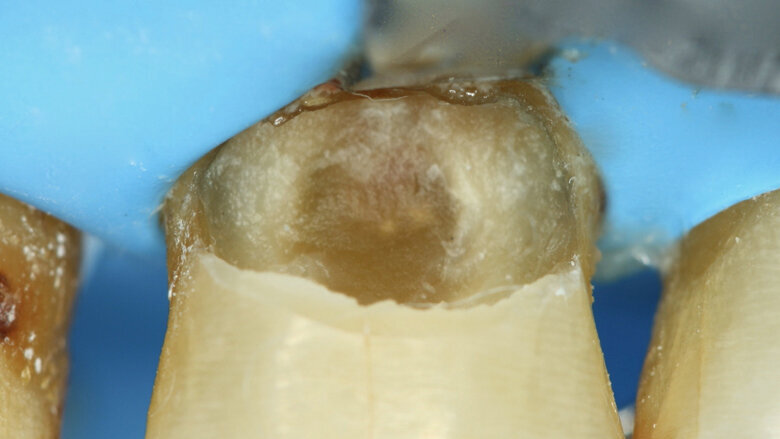 Figuras 11 y 12. Se coloca silicato de calcio modificado por resina por la proximidad a la pulpa. 