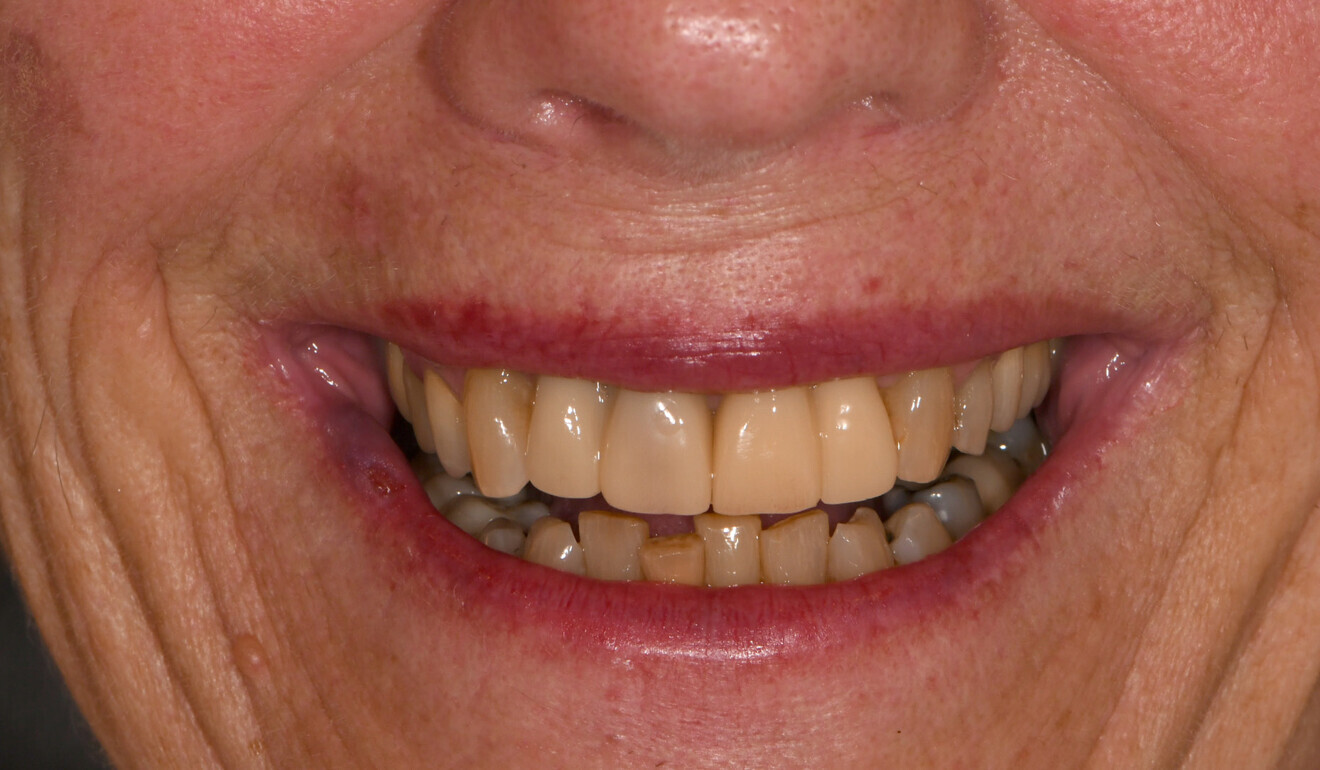 Fig. 9: Long-term temporary restorations in place, frontal view.